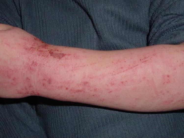 Eczema Causes and Treatment [Definitive Guide]