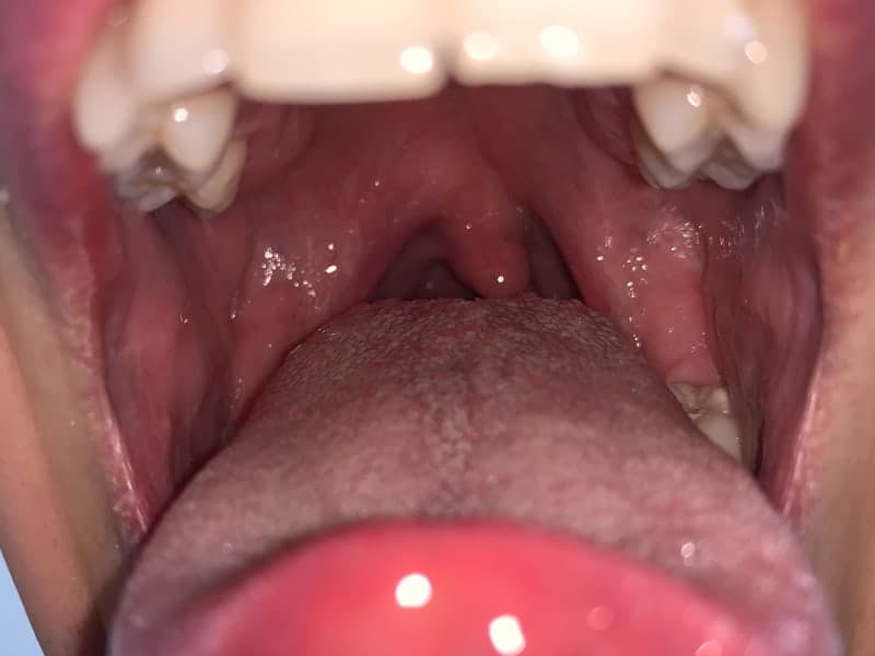 tonsillitis-symptoms-plus-treatment-definitive-guide